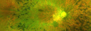Professor Robert MacLaren's retinal gene therapy.